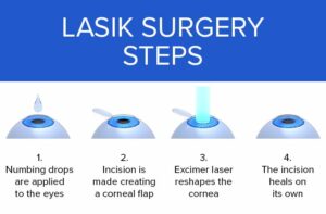 Understanding LASIK Eye Surgery