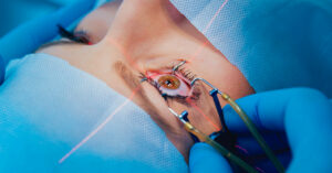 Why is a LASIK Eye Surgery Consultation Necessary?