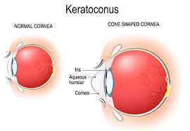 How Can I Choose PRK And CXL For Keratoconus?
