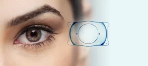 intraocular contact lenses